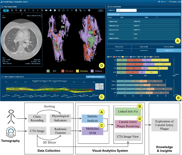 Figure 2 for An Integrated Visual Analytics System for Studying Clinical Carotid Artery Plaques