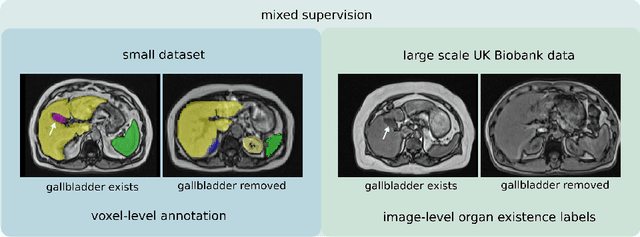 Figure 1 for HALOS: Hallucination-free Organ Segmentation after Organ Resection Surgery