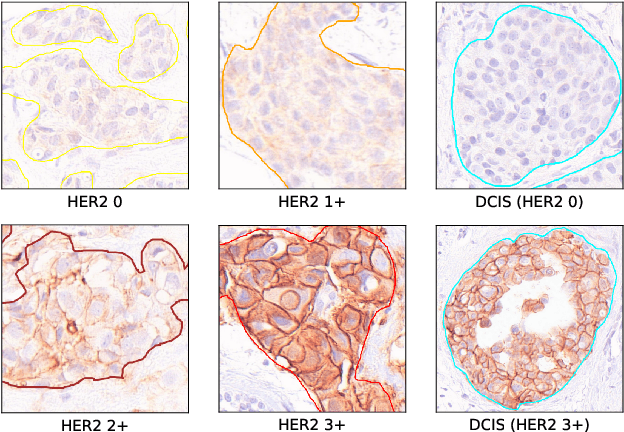 Figure 1 for Improved HER2 Tumor Segmentation with Subtype Balancing using Deep Generative Networks