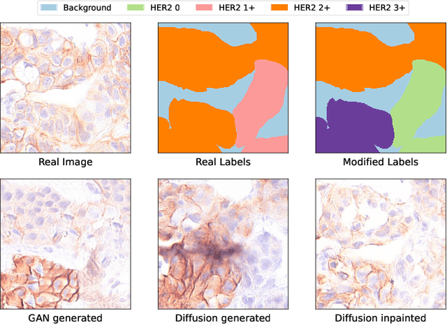 Figure 4 for Improved HER2 Tumor Segmentation with Subtype Balancing using Deep Generative Networks