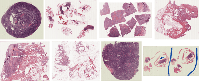 Figure 1 for Predicting Ovarian Cancer Treatment Response in Histopathology using Hierarchical Vision Transformers and Multiple Instance Learning