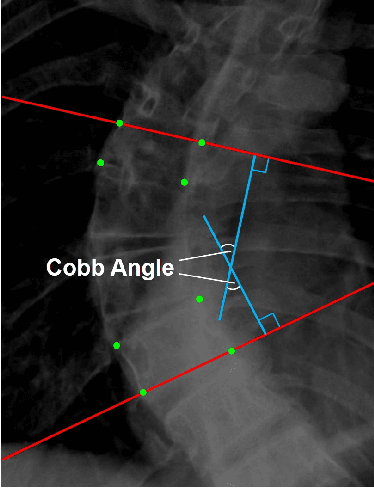 Figure 1 for MMA-Net: Multiple Morphology-Aware Network for Automated Cobb Angle Measurement