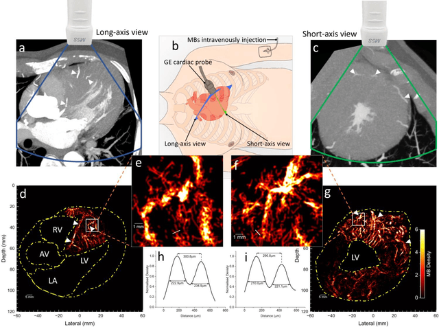 Figure 3 for Transthoracic super-resolution ultrasound localisation microscopy of myocardial vasculature in patients