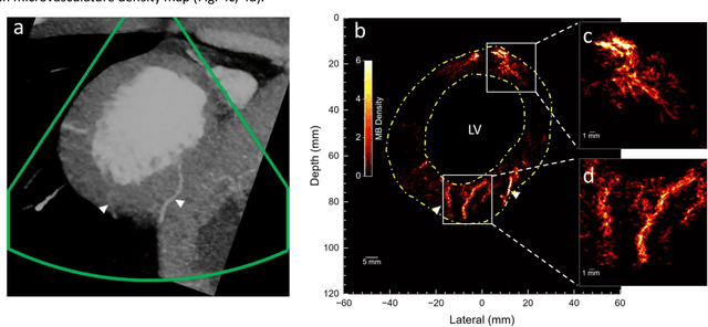Figure 4 for Transthoracic super-resolution ultrasound localisation microscopy of myocardial vasculature in patients