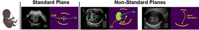 Figure 1 for Diffusion-based Iterative Counterfactual Explanations for Fetal Ultrasound Image Quality Assessment