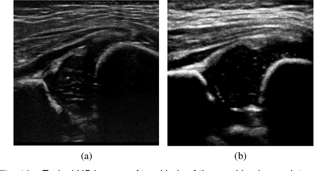 Figure 2 for Joint Landmark and Structure Learning for Automatic Evaluation of Developmental Dysplasia of the Hip