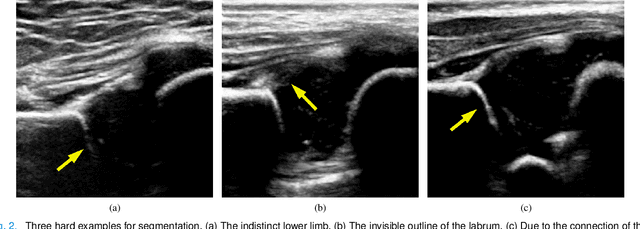 Figure 3 for Joint Landmark and Structure Learning for Automatic Evaluation of Developmental Dysplasia of the Hip