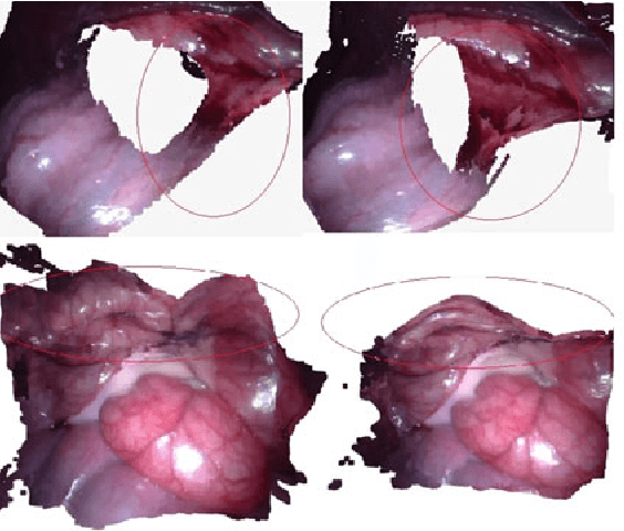 Figure 3 for Dynamic Reconstruction of Deformable Soft-tissue with Stereo Scope in Minimal Invasive Surgery