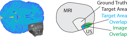 Figure 1 for Initialize globally before acting locally: Enabling Landmark-free 3D US to MRI Registration