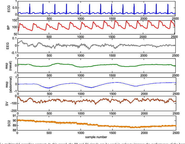 Figure 3 for Robust heartbeat detection using multimodal recordings and ECG quality assessment with signal amplitudes dispersion