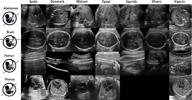 Figure 1 for Generalisability of deep learning models in low-resource imaging settings: A fetal ultrasound study in 5 African countries