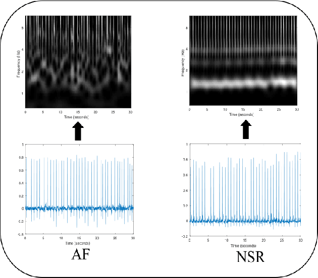 Figure 3 for Detection of Paroxysmal Atrial Fibrillation using Attention-based Bidirectional Recurrent Neural Networks