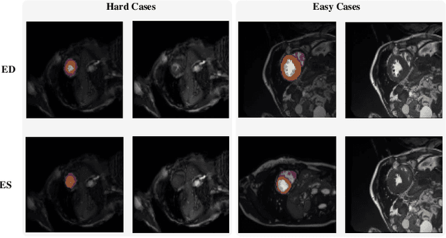 Figure 2 for Myocardial Segmentation of Cardiac MRI Sequences with Temporal Consistency for Coronary Artery Disease Diagnosis