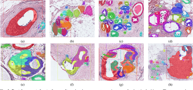 Figure 3 for Classifying Breast Histopathology Images with a Ductal Instance-Oriented Pipeline