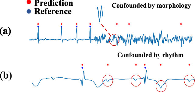Figure 1 for A Causal Intervention Scheme for Semantic Segmentation of Quasi-periodic Cardiovascular Signals