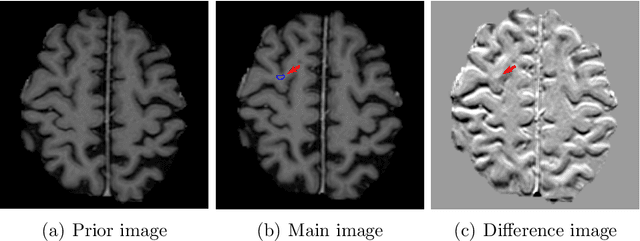 Figure 1 for Deep learning for brain metastasis detection and segmentation in longitudinal MRI data