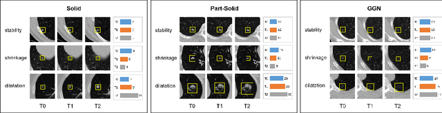 Figure 3 for Siamese Encoder-based Spatial-Temporal Mixer for Growth Trend Prediction of Lung Nodules on CT Scans