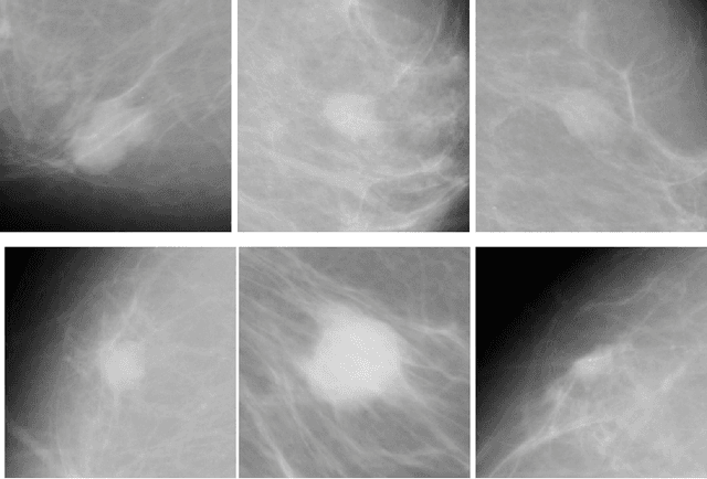 Figure 3 for An Efficient Automatic Mass Classification Method In Digitized Mammograms Using Artificial Neural Network