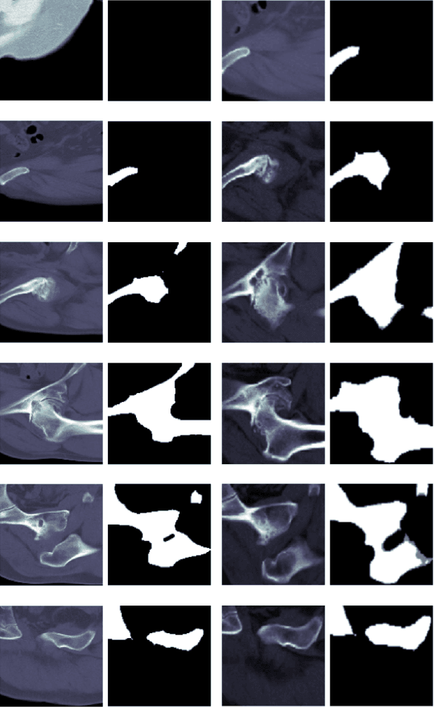 Figure 4 for Structure Regularized Attentive Network for Automatic Femoral Head Necrosis Diagnosis and Localization