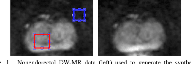 Figure 1 for Noise-Compensated, Bias-Corrected Diffusion Weighted Endorectal Magnetic Resonance Imaging via a Stochastically Fully-Connected Joint Conditional Random Field Model
