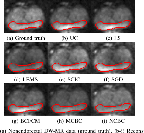 Figure 2 for Noise-Compensated, Bias-Corrected Diffusion Weighted Endorectal Magnetic Resonance Imaging via a Stochastically Fully-Connected Joint Conditional Random Field Model