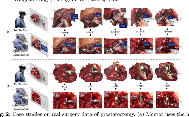 Figure 2 for Robotic Surgery Remote Mentoring via AR with 3D Scene Streaming and Hand Interaction