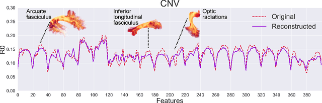 Figure 3 for Tractometry-based Anomaly Detection for Single-subject White Matter Analysis