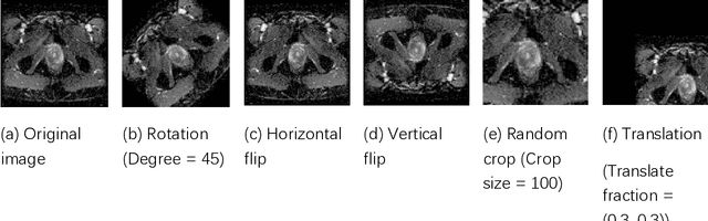 Figure 1 for A Comprehensive Study of Data Augmentation Strategies for Prostate Cancer Detection in Diffusion-weighted MRI using Convolutional Neural Networks