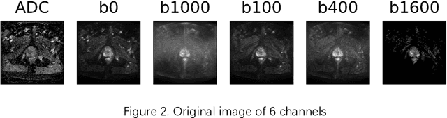 Figure 3 for A Comprehensive Study of Data Augmentation Strategies for Prostate Cancer Detection in Diffusion-weighted MRI using Convolutional Neural Networks