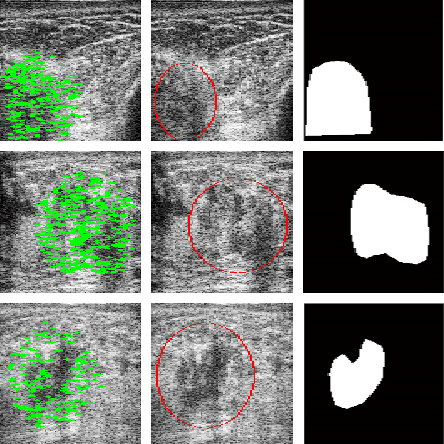 Figure 2 for Tumour Ellipsification in Ultrasound Images for Treatment Prediction in Breast Cancer