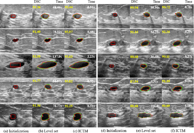 Figure 2 for A Fast Algorithm for Geodesic Active Contours with Applications to Medical Image Segmentation