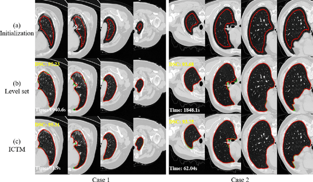 Figure 3 for A Fast Algorithm for Geodesic Active Contours with Applications to Medical Image Segmentation