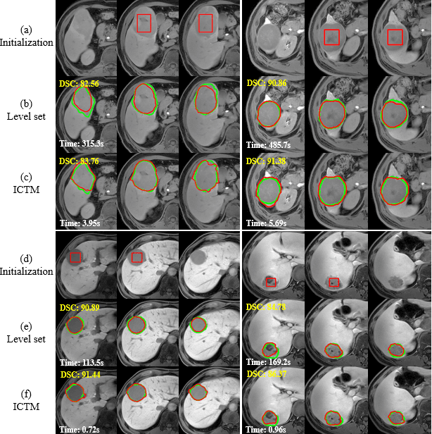 Figure 4 for A Fast Algorithm for Geodesic Active Contours with Applications to Medical Image Segmentation