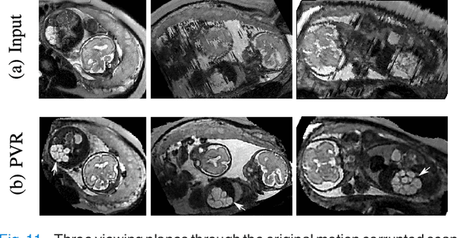 Figure 3 for PVR: Patch-to-Volume Reconstruction for Large Area Motion Correction of Fetal MRI