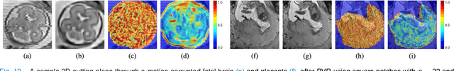 Figure 4 for PVR: Patch-to-Volume Reconstruction for Large Area Motion Correction of Fetal MRI