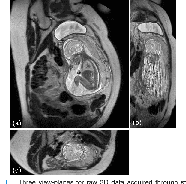 Figure 1 for PVR: Patch-to-Volume Reconstruction for Large Area Motion Correction of Fetal MRI