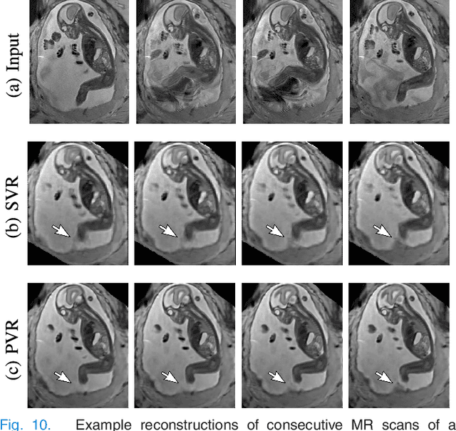 Figure 2 for PVR: Patch-to-Volume Reconstruction for Large Area Motion Correction of Fetal MRI
