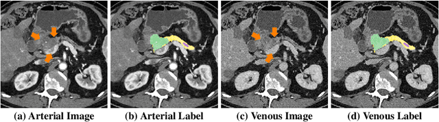 Figure 1 for Hyper-Pairing Network for Multi-Phase Pancreatic Ductal Adenocarcinoma Segmentation