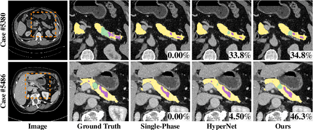 Figure 4 for Hyper-Pairing Network for Multi-Phase Pancreatic Ductal Adenocarcinoma Segmentation