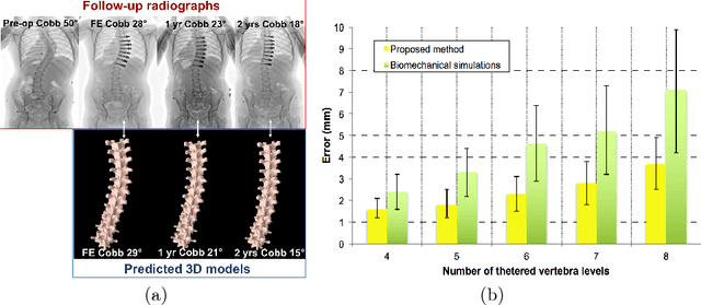 Figure 3 for Spatiotemporal Manifold Prediction Model for Anterior Vertebral Body Growth Modulation Surgery in Idiopathic Scoliosis