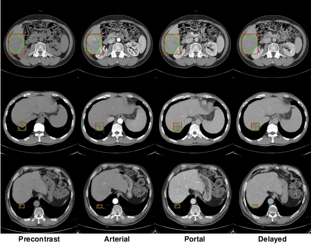 Figure 1 for Robust End-to-End Focal Liver Lesion Detection using Unregistered Multiphase Computed Tomography Images