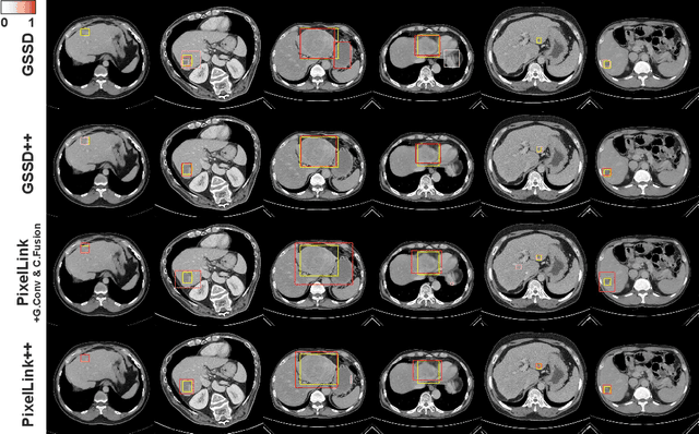 Figure 4 for Robust End-to-End Focal Liver Lesion Detection using Unregistered Multiphase Computed Tomography Images