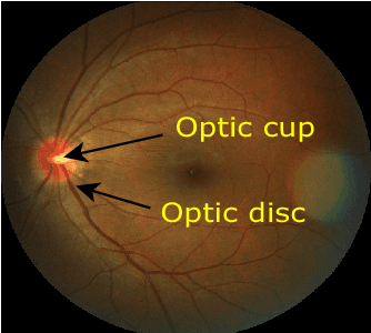 Figure 1 for REFUGE CHALLENGE 2018-Task 2:Deep Optic Disc and Cup Segmentation in Fundus Images Using U-Net and Multi-scale Feature Matching Networks