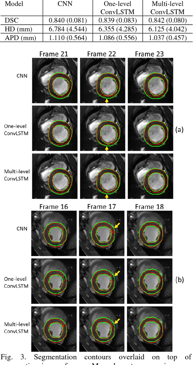 Figure 3 for A multi-level convolutional LSTM model for the segmentation of left ventricle myocardium in infarcted porcine cine MR images
