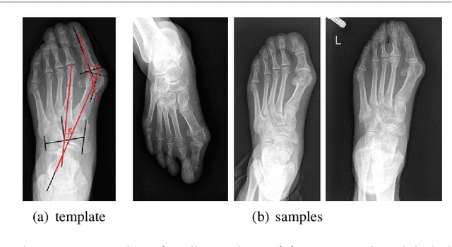 Figure 1 for A Dataset and Method for Hallux Valgus Angle Estimation Based on Deep Learing