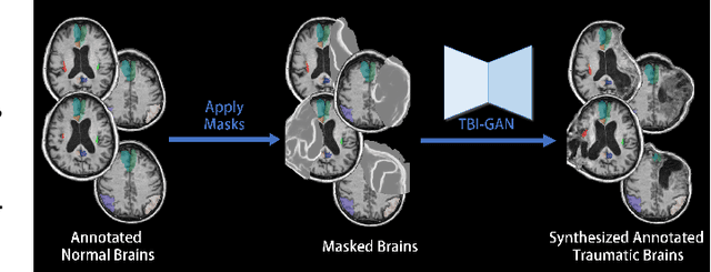Figure 1 for TBI-GAN: An Adversarial Learning Approach for Data Synthesis on Traumatic Brain Segmentation