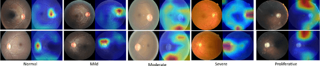 Figure 3 for Two Eyes Are Better Than One: Exploiting Binocular Correlation for Diabetic Retinopathy Severity Grading