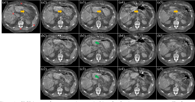 Figure 3 for Deformable Image Registration using Unsupervised Deep Learning for CBCT-guided Abdominal Radiotherapy