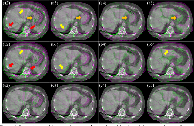 Figure 4 for Deformable Image Registration using Unsupervised Deep Learning for CBCT-guided Abdominal Radiotherapy