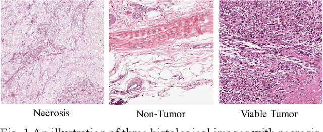 Figure 1 for Noise-reducing attention cross fusion learning transformer for histological image classification of osteosarcoma